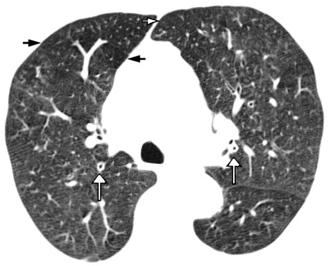 Chest Radiographs And CT Scans For Asthma Analysis.